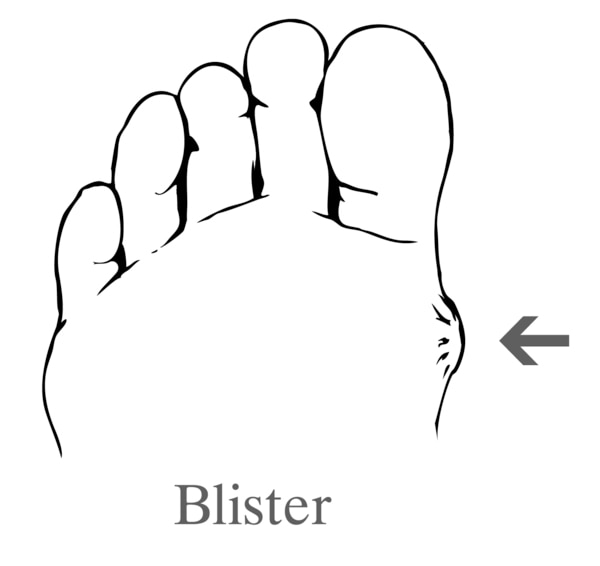 Drawing of a foot with a blister.