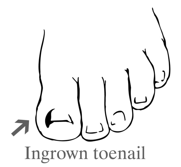 Drawing of a foot showing an ingrown toenail.