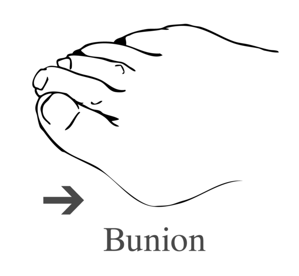 Drawing of a foot showing a bunion.