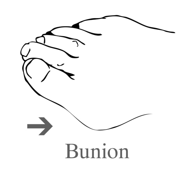 Drawing of a foot showing a bunion.