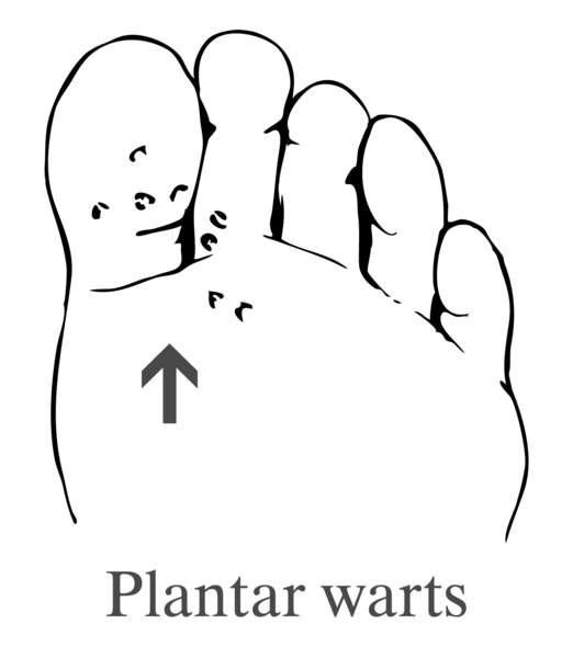 Drawing of a foot showing plantar warts.