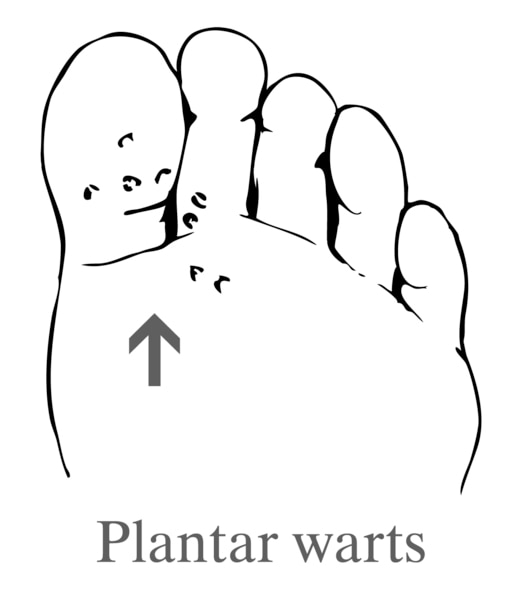 Drawing of a foot showing plantar warts.