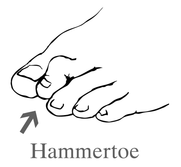 Drawing of a foot showing a hammertoe.