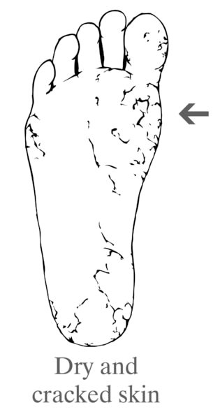 Drawing of a foot showing dry and cracked skin.