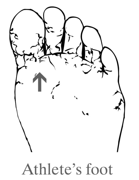 Drawing of a foot showing athlete's foot.