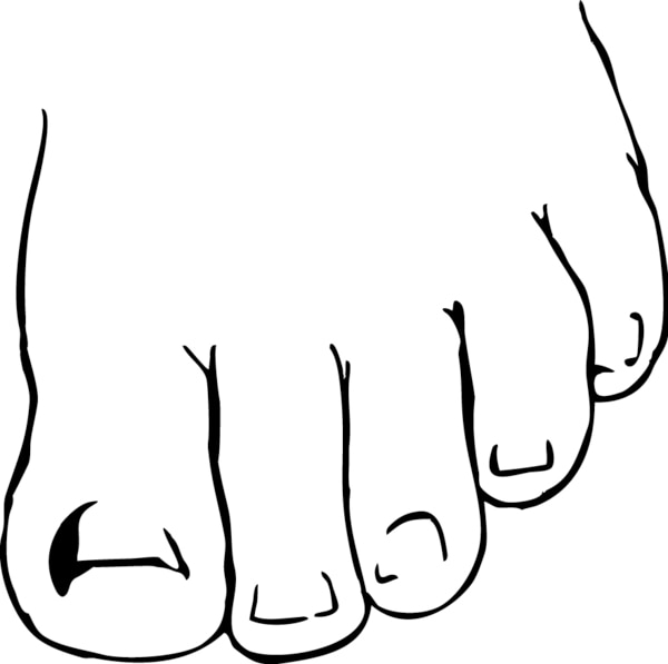 Drawing of a foot with an ingrown toenail.