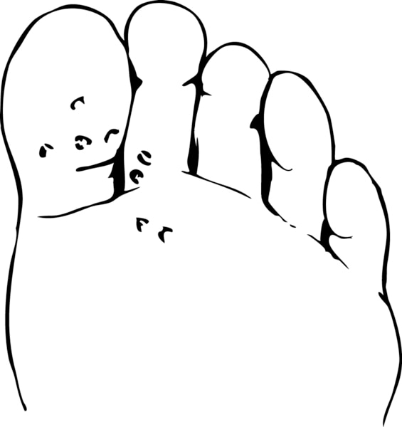 Drawing of a foot with plantar warts.