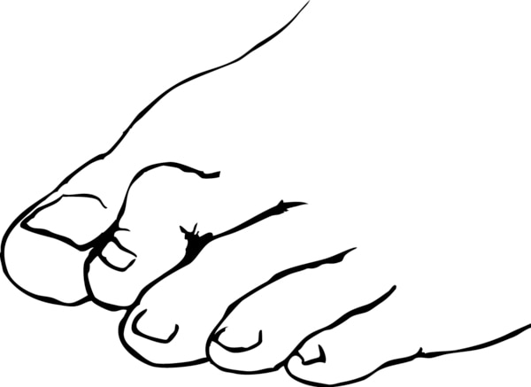 Drawing of a foot with a hammertoe.