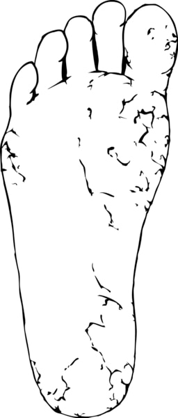 Drawing of a foot with dry and cracked skin.