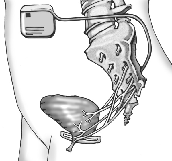 Drawing of a bladder, tailbone, and nerves leading to the bladder. An implanted device delivers mild electrical pulses to the nerves that control bladder function.