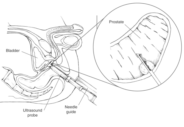 Cross-section diagram of transrectal prostate biopsy with ultrasound probe guiding the needle to the prostate. An inset shows a close-up of a needle entering the prostate.