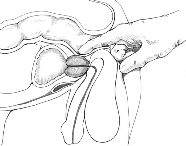 Cross-section diagram of a digital rectal examination showing the physician's index finger inserted into the patient's rectum to feel the size and shape of the prostate.