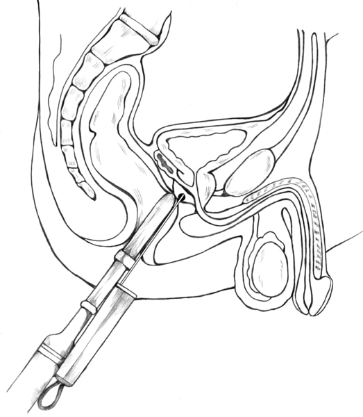 Cross-section diagram of a transrectal prostate biopsy with an ultrasound probe guiding the needle to the prostate.