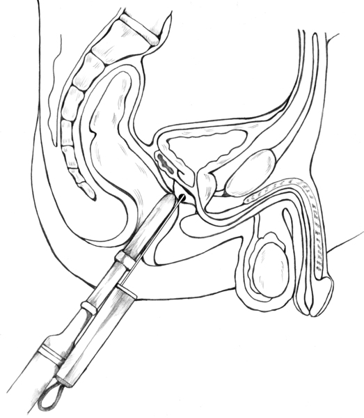Cross-section diagram of a transrectal prostate biopsy with an ultrasound probe guiding the needle to the prostate.