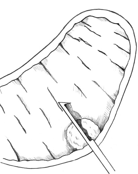 Drawing of a biopsy needle collecting prostate tissue, including tissue from a suspected tumor.