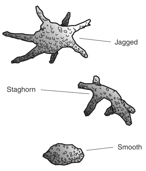 Drawing of three kidney stones of various shapes. The stones are labeled jagged, staghorn, and smooth.