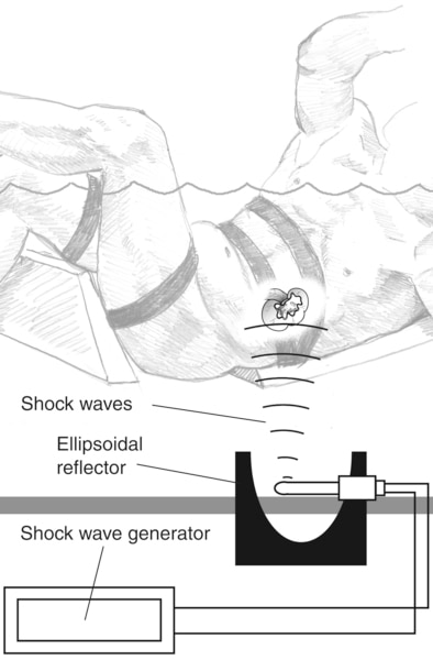 Drawing of a patient receiving extracorporeal shock wave lithotripsy. The patient is submerged in water up to the shoulders. Labels point to a shock wave generator, ellipsoidal reflector, and shock waves.