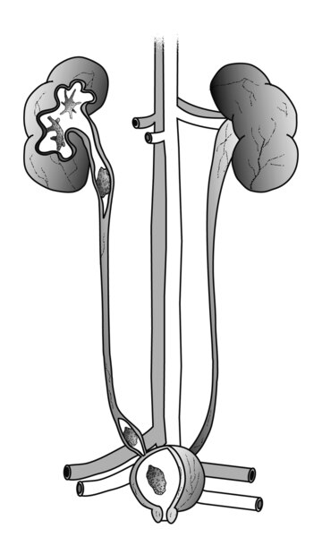 Drawing of urinary tract with stones in the kidney, ureter, and bladder.