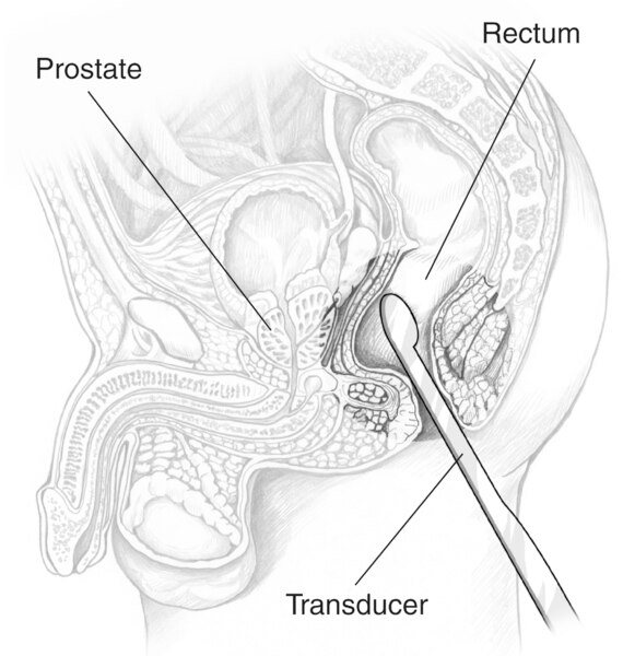 Cross-section drawing of a male pelvis with an ultrasound transducer inserted into the rectum to examine the prostate.  Labels point to the prostate, rectum, and transducer.