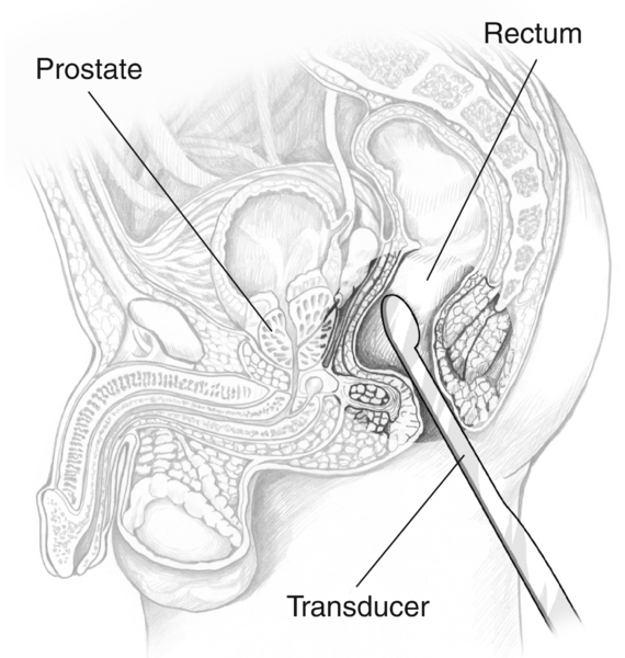 Cross-section drawing of a male pelvis with an ultrasound transducer inserted into the rectum to examine the prostate. Labels point to the prostate, rectum, and transducer.