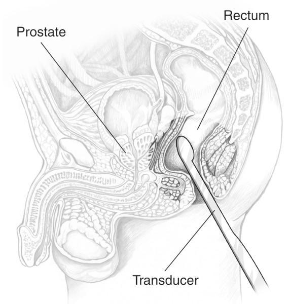 Cross-section drawing of a male pelvis with an ultrasound transducer inserted into the rectum to examine the prostate.  Labels point to the prostate, rectum, and transducer.