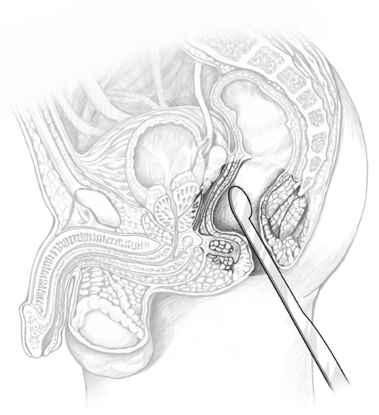Cross-section drawing of a male pelvis with an ultrasound transducer inserted in the rectum to examine the prostate.