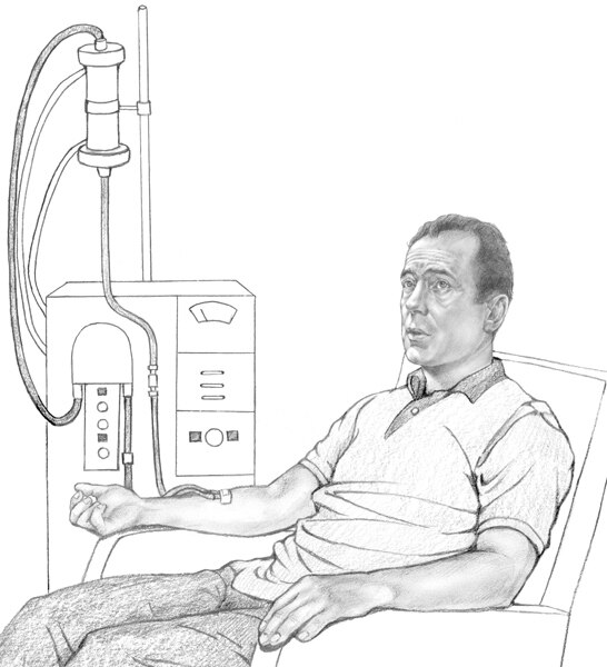 Drawing of a man receiving hemodialysis treatment.