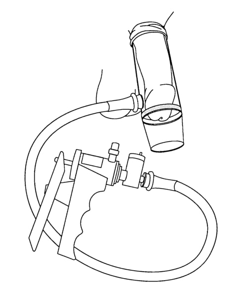 Drawing of a vacuum-constrictor device for erectile dysfunction.