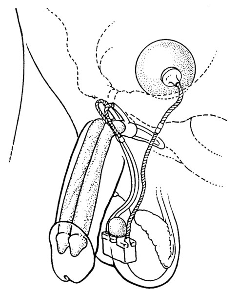 Drawing of a device implanted in the penis. Two cylinders run through the penis. A ball of fluid sits in the pelvis, and a pump sits in the scrotum.