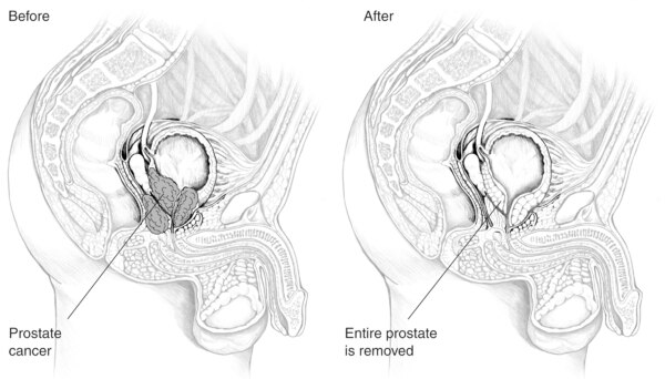 Drawings of the male urinary tract. The left drawing, labeled "Before," shows the urinary tract with the prostate intact. The right drawing, labeled "After," shows the urinary tract with the prostate removed. Additional labels point to the prostate (left)
