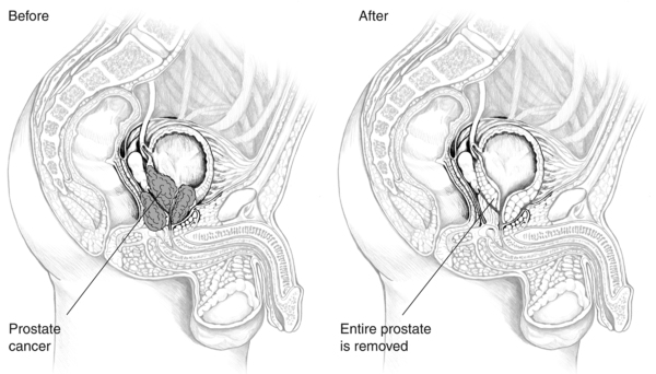 Drawings of the male urinary tract. The left drawing, labeled "Before," shows the urinary tract with the prostate intact. The right drawing, labeled "After," shows the urinary tract with the prostate removed. Additional labels point to the prostate (left)