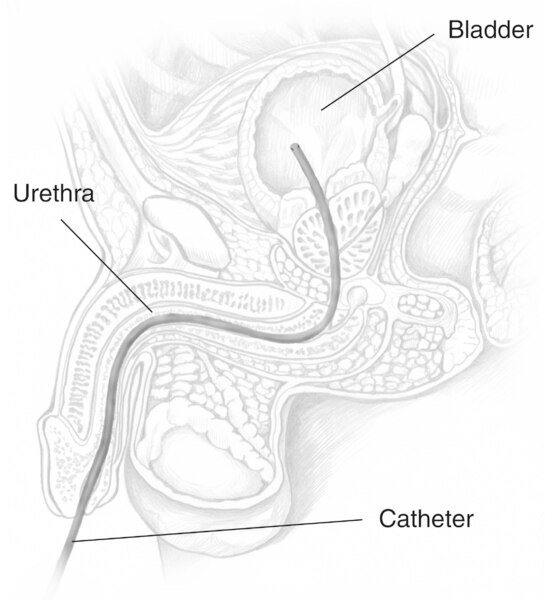 Drawing of the male urinary tract with a catheter placed through the urethra to the bladder. Labels identify the catheter, urethra, and bladder.