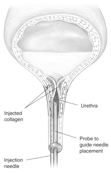 Drawing of a bladder and upper urethra. A needle inserted through the urethra delivers collagen to the tissue around the bladder opening. Labels point to the injected collagen, urethra, probe to guide needle placement, and injection needle.
