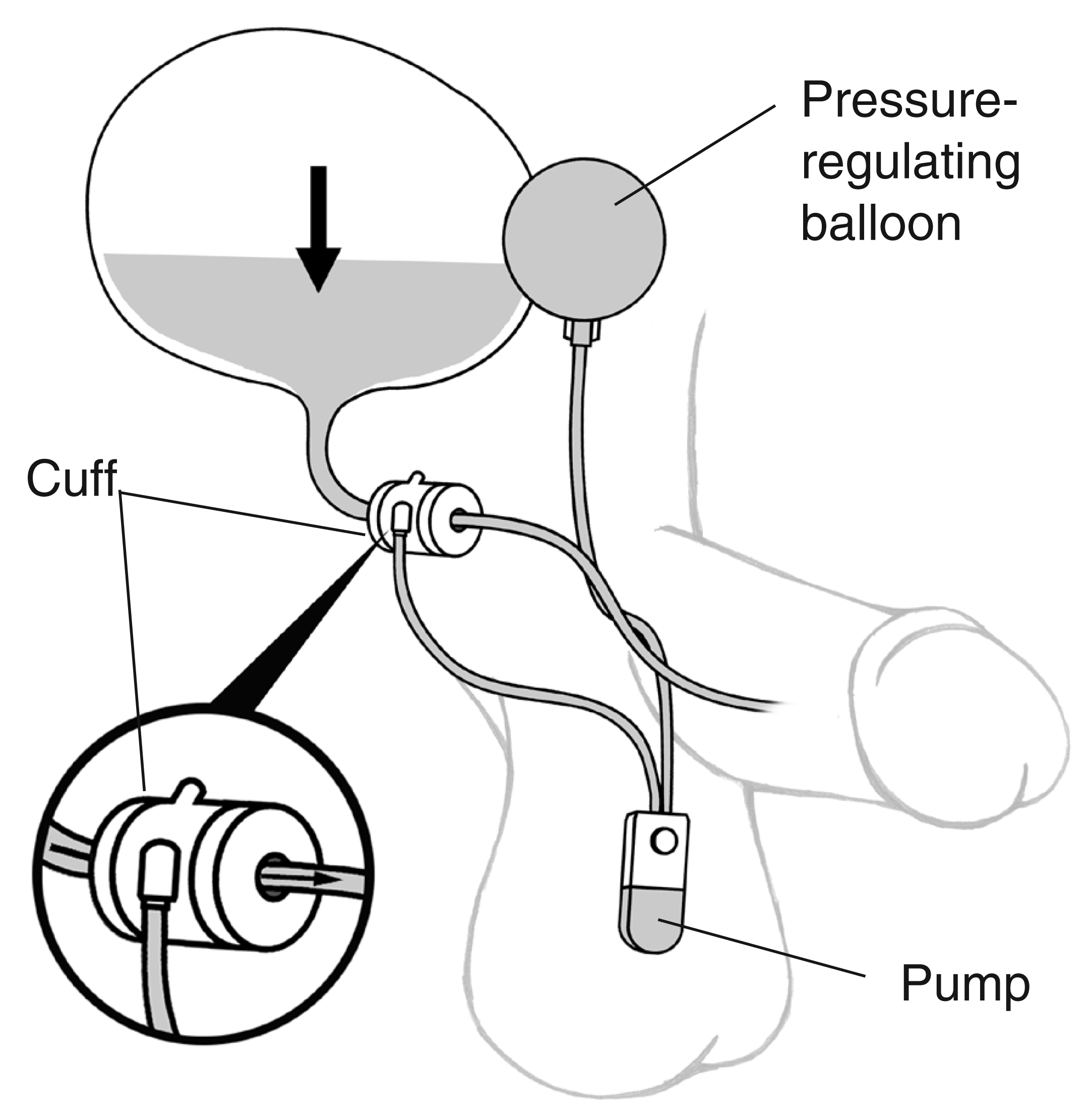 An artificial sphincter to treat male urinary incontinence with labels