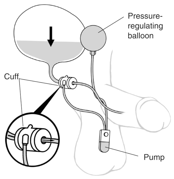 Drawing of an artificial sphincter to treat male urinary incontinence. Labels point to a pump in the scrotum, a cuff around the urethra, and a pressure-regulating balloon inside the bladder. An inset shows a close-up of the cuff around the urethra.