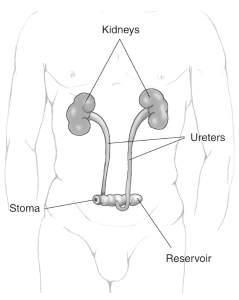 Drawing of an ileal conduit urinary diversion. The urinary diversion is shown within the outline of a male figure. Labels point to the kidneys, ureters, stoma, and reservoir.