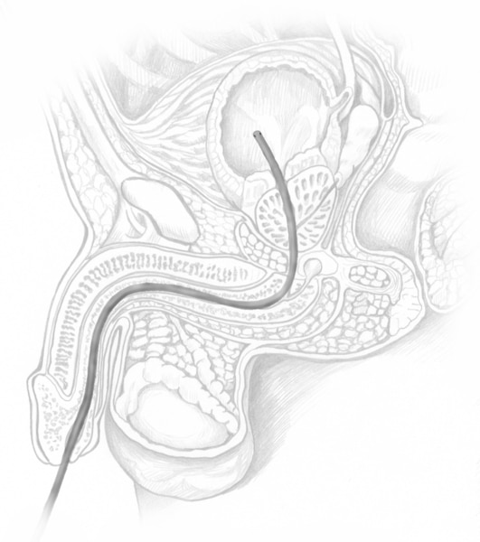 Drawing of the male urinary tract with a catheter placed through the urethra to the bladder.