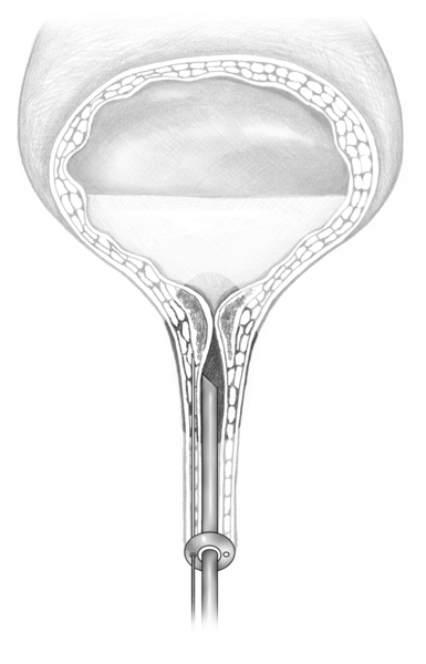 Drawing of a bladder and upper urethra. A needle inserted through the urethra delivers collagen to the tissue around the bladder opening.