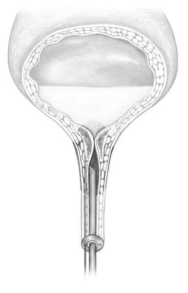 Drawing of a bladder and upper urethra. A needle inserted through the urethra delivers collagen to the tissue around the bladder opening.