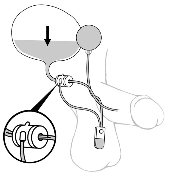 Drawing of an artificial sphincter used to treat male urinary incontinence.