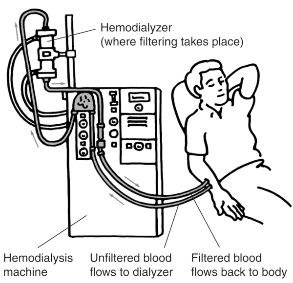 Drawing of a patient on hemodialysis. One set of tubes takes the patient's blood from the patient's arm to the dialyzer. Another set of tubes returns the blood to the patient's body.