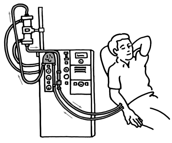Drawing of a patient on hemodialysis. One set of tubes takes the patient's blood from the patient's arm to the dialyzer. Another set of tubes returns the blood to the patient's body.