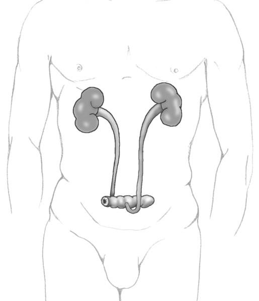 Drawing of an ileal conduit urinary diversion. The urinary diversion is shown within the outline of a male figure. The kidneys, ureters, and conduit made from a section of intestine are visible.