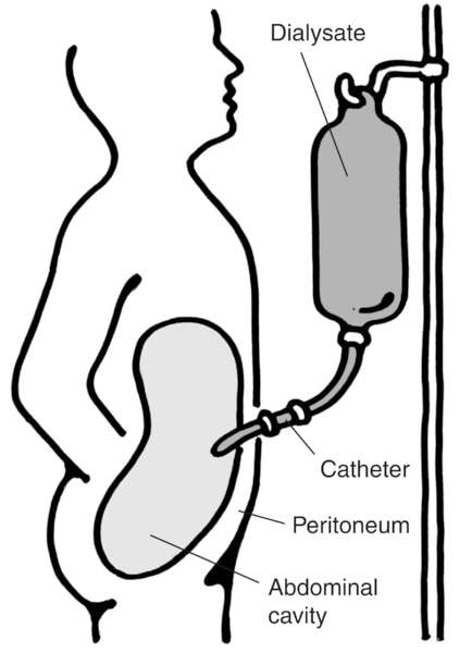 Diagram of a patient receiving continuous ambulatory peritoneal dialysis. Labels point to the dialysis solution, catheter, peritoneum, and abdominal cavity.