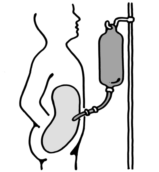 Diagram of a patient receiving continuous ambulatory peritoneal dialysis.