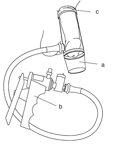 Drawing of a vacuum-constrictor device placed around the penis. Pictured here are the necessary components: (a) a plastic cylinder, which covers the penis; (b) a pump, which draws air out of the cylinder; (c) an elastic ring, which, when fitted over the b
