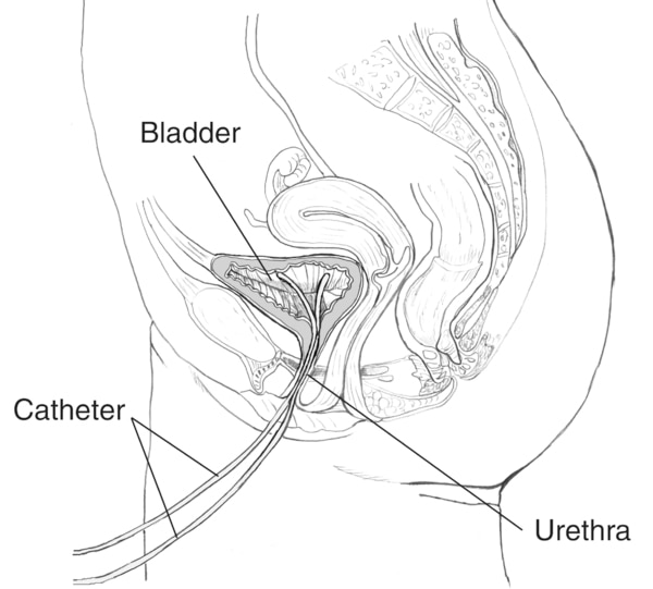 Drawing of the side view of the female urinary tract with a catheter inserted through the urethra to the bladder. The catheter, urethra, and bladder are labeled.