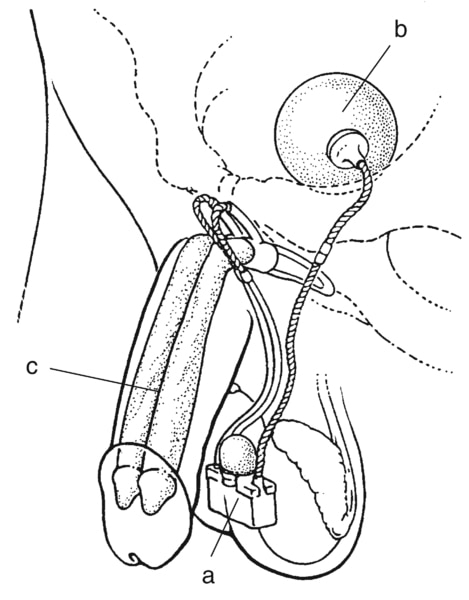 Drawing of an inflatable implant to treat erectile dysfunction. An erection is produced by squeezing a small pump (a) implanted in a scrotum. The pump causes fluid to flow from a reservoir (b) residing in the lower pelvis to two cylinders (c) residing in