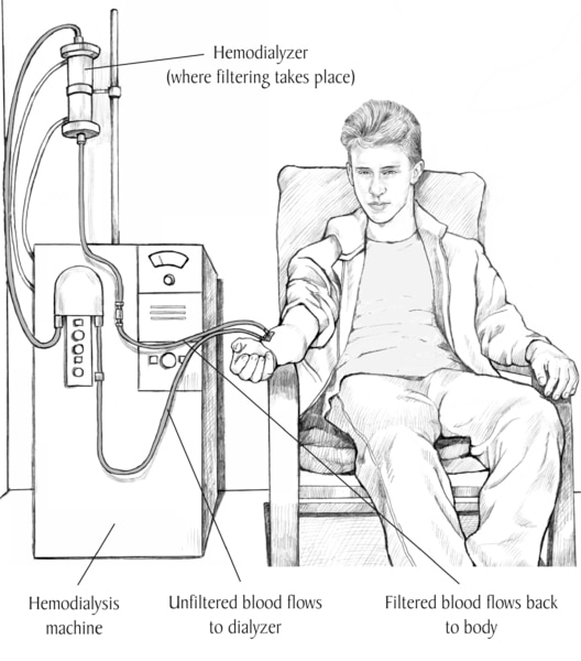 Picture of a teenage boy receiving hemodialysis treatment. Labels point to the dialyzer, where filtering takes place; hemodialysis machine; a tube where unfiltered blood flows to the dialyzer; and a tube where filtered blood flows back to the patient.