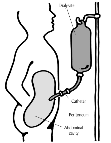 Diagram of patient performing peritoneal dialysis.